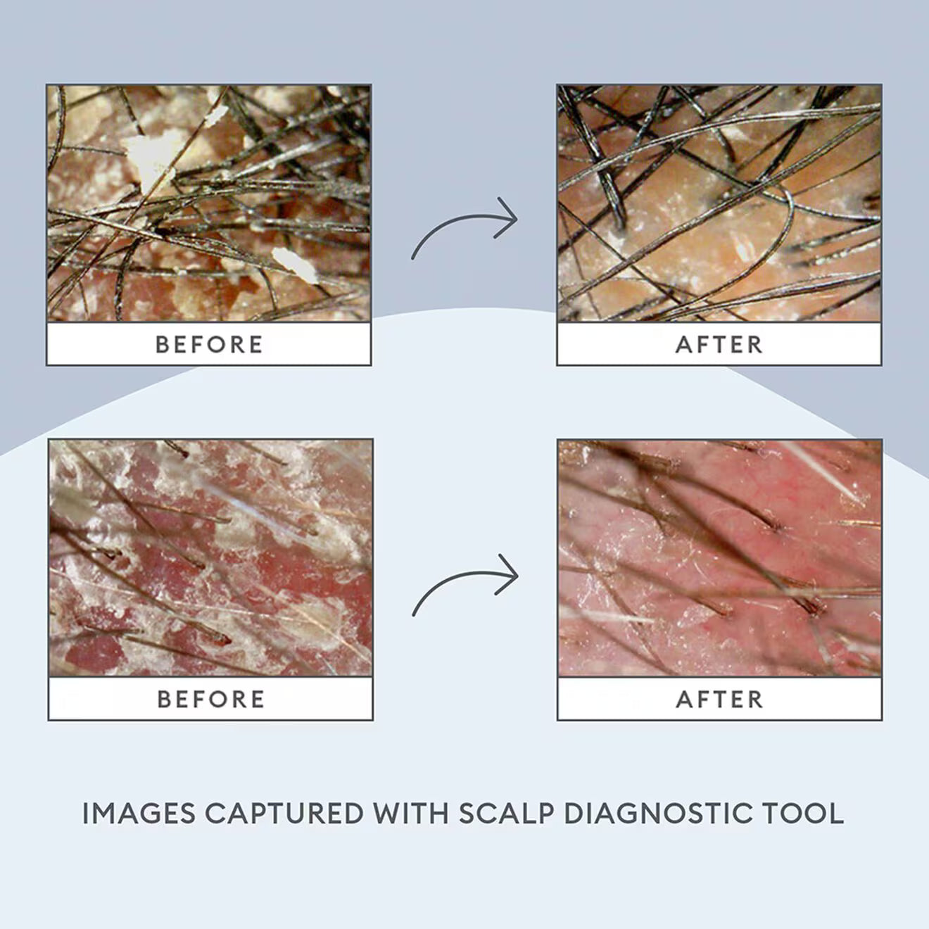 Scalp Revival™ Charcoal + Tea Tree Scalp Treatment Serum