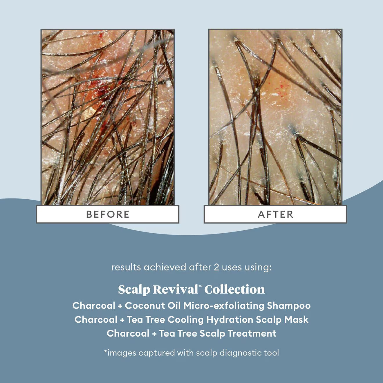 Scalp Revival™ Charcoal + Tea Tree Scalp Treatment Serum