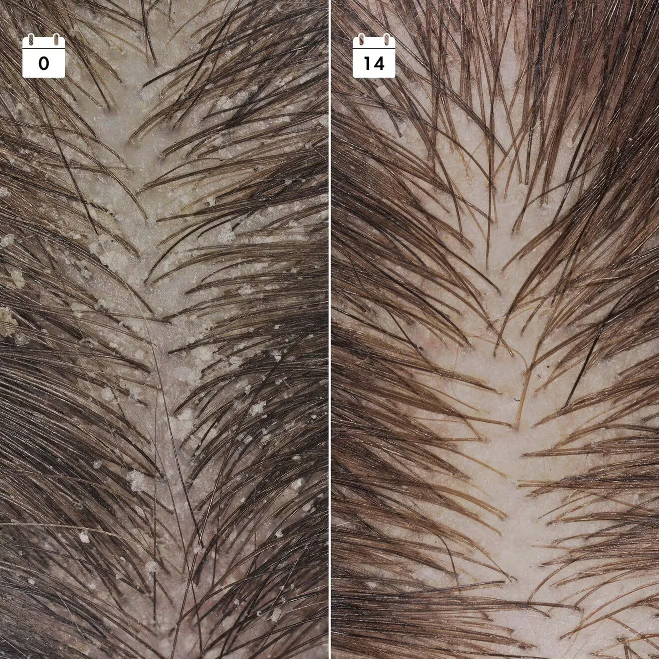 Anti-Recurrence Dandruff Serum - Scalp Serum