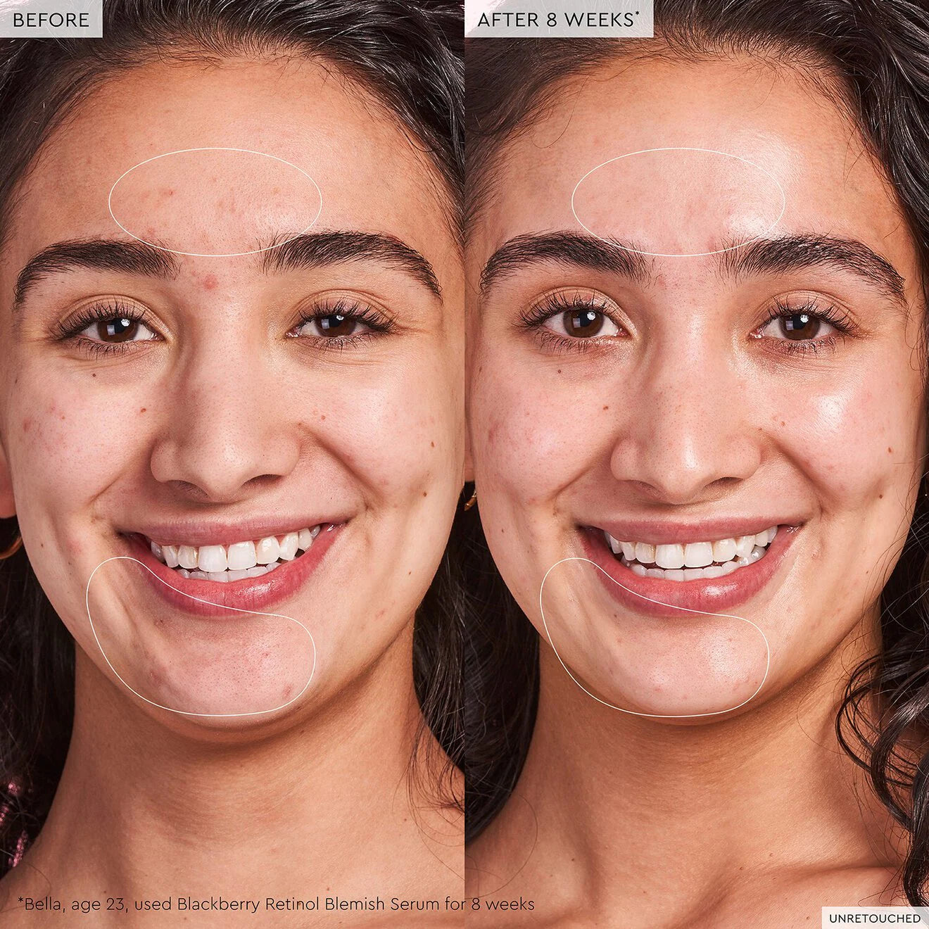 Blackberry Retinol Blemish Serum