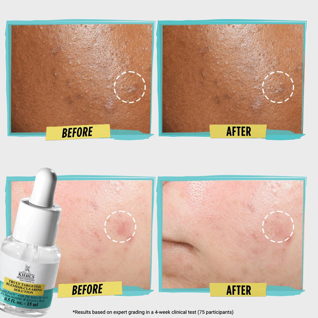 Truly Targeted Blemish-Clearing Solution with Salicylic Acid