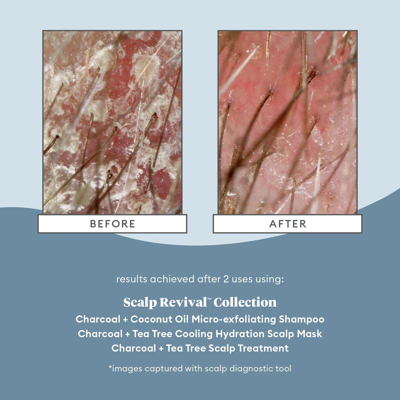 Scalp Revival™ Charcoal + Tea Tree Scalp Treatment Serum