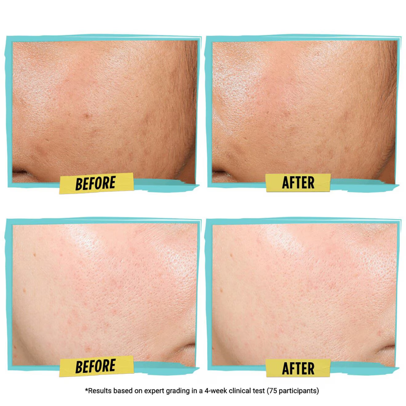Expertly Clear Blemish-treating & Preventing Lotion
