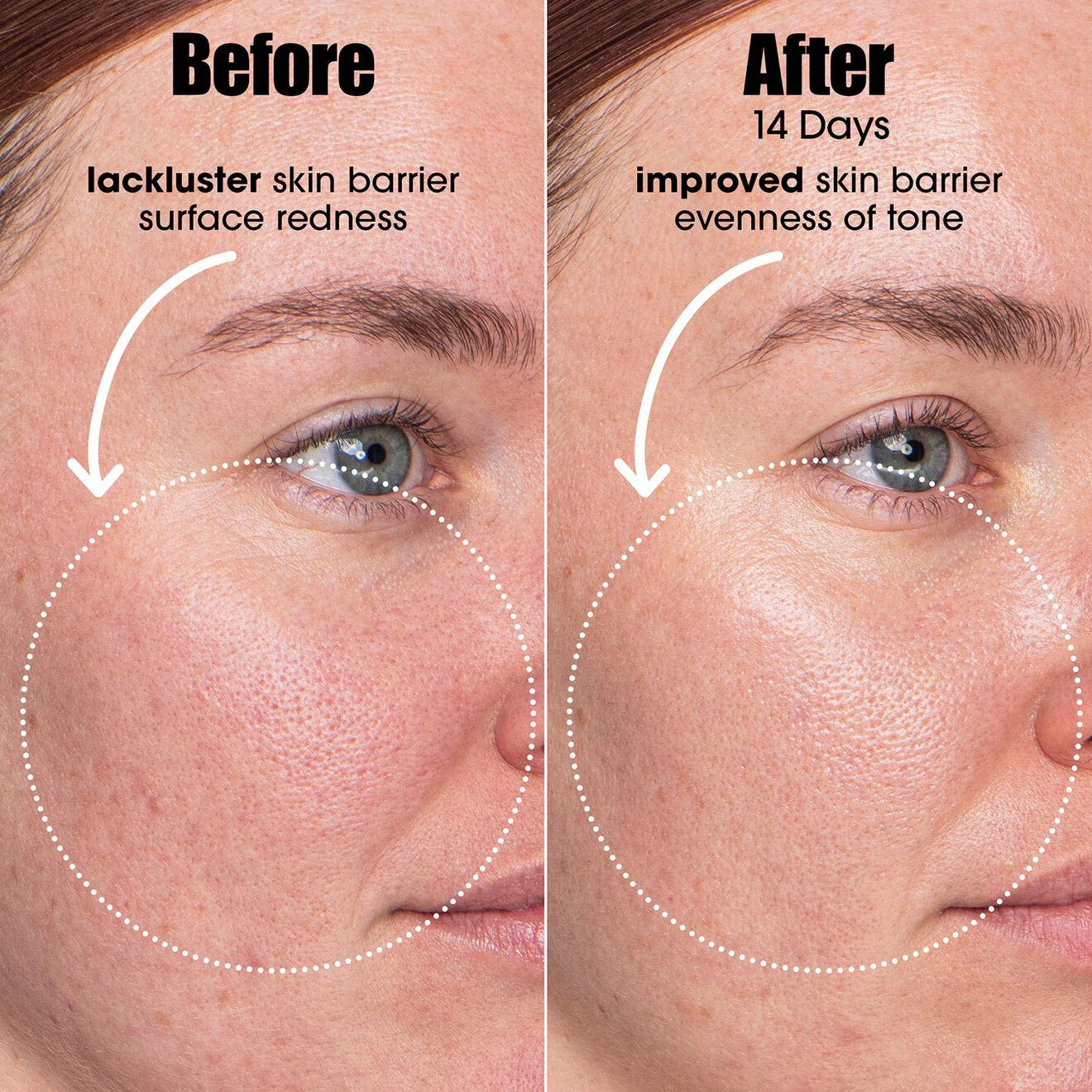 AI Smart Retinoid for Blemish-Prone Skin