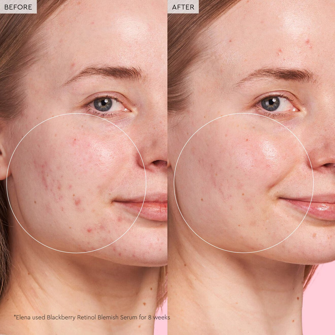 Blackberry Retinol Blemish Serum